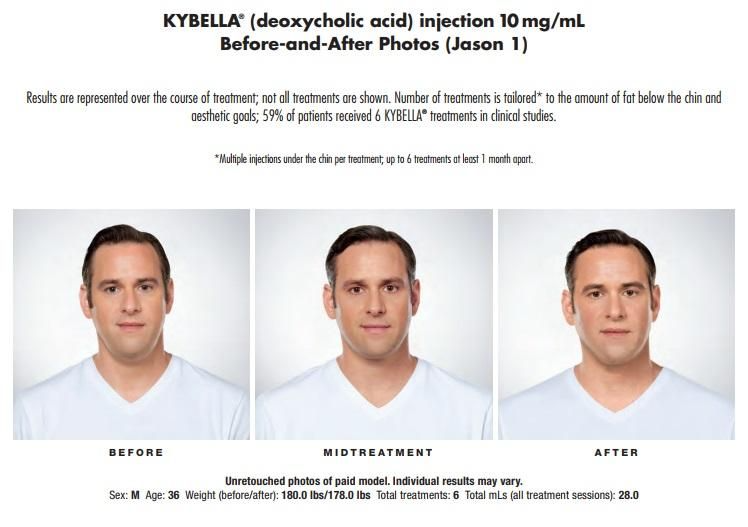 Kybella Treatment