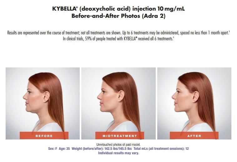 Kybella Treatment