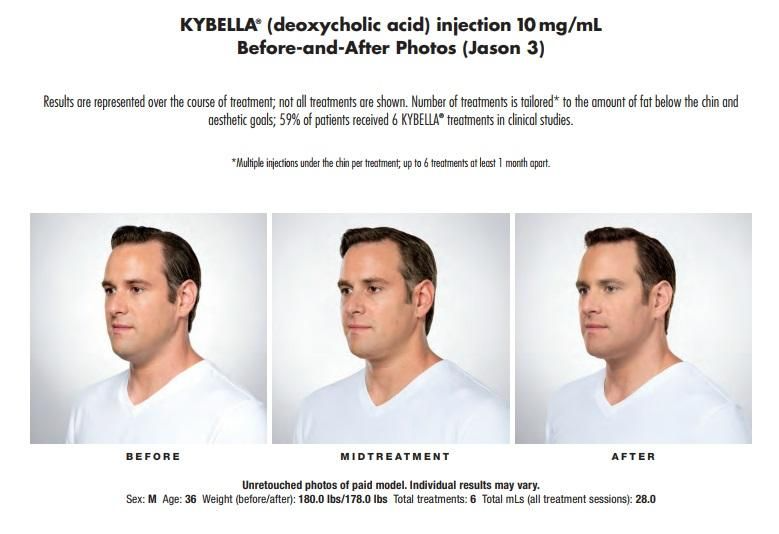 Kybella Treatment