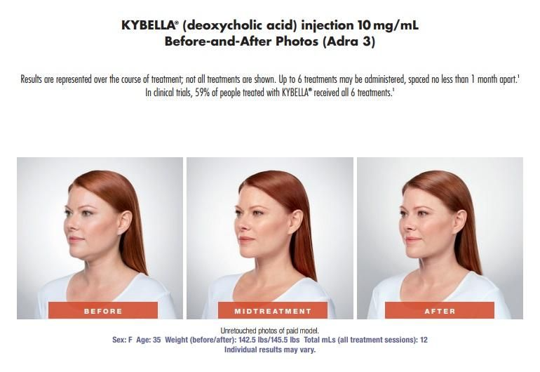 Kybella Treatment