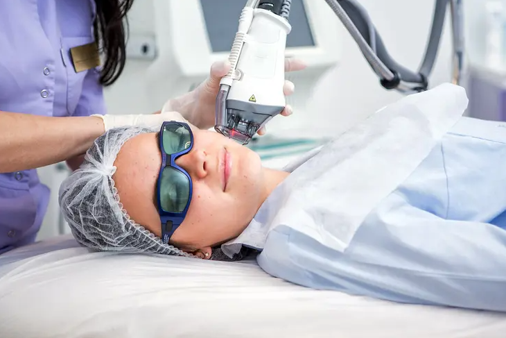 IPL Photorejuvenation