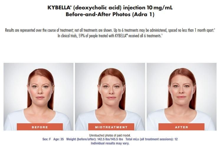 Kybella Treatment